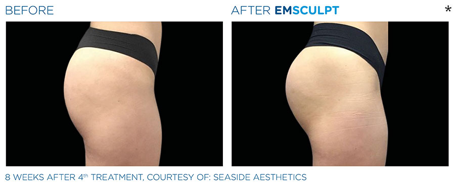 Before and After Photo of Butt Lift Treatment in San Francisco